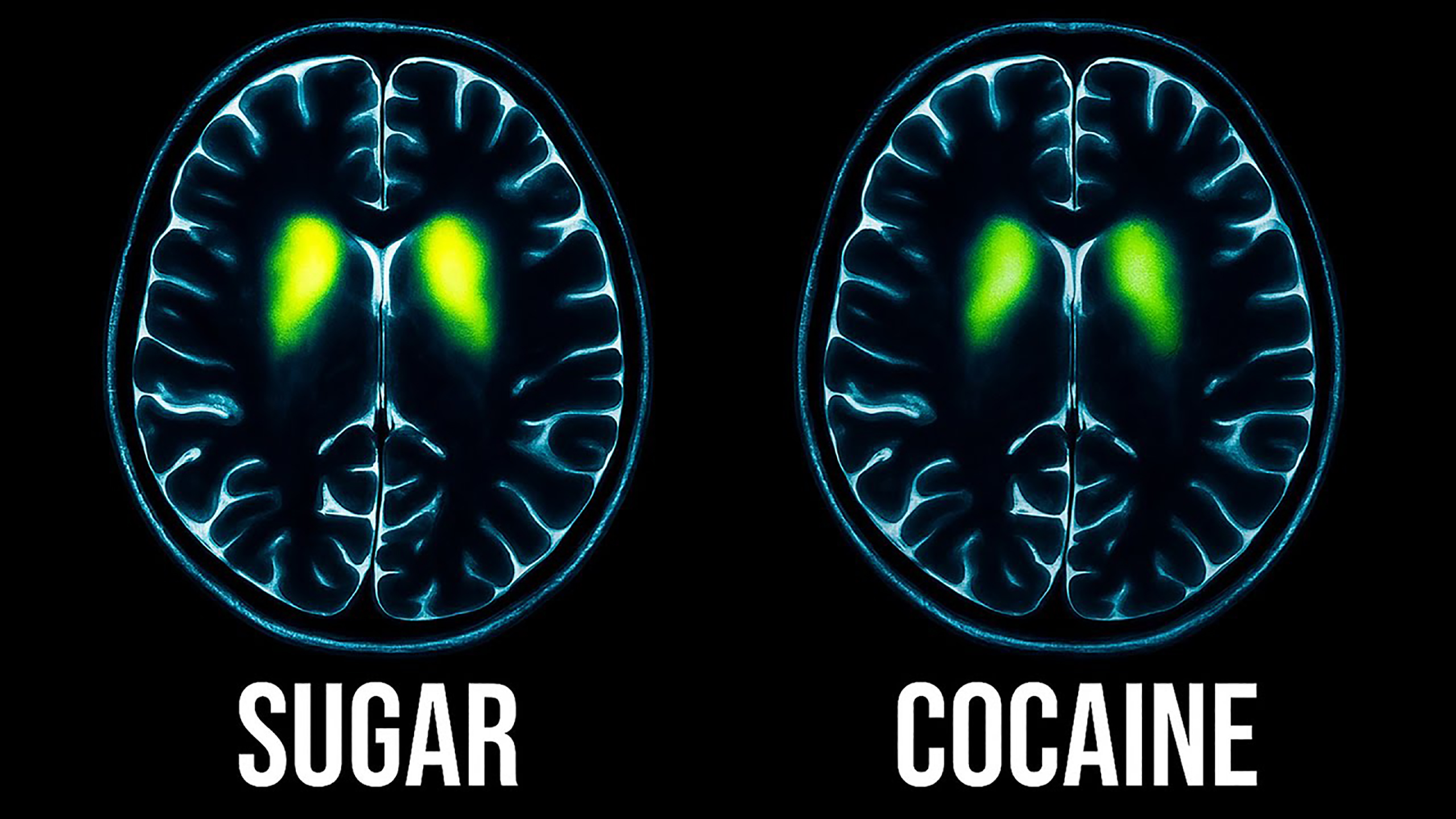 Wellness in the World: Your Brain on Sugar – Part 2